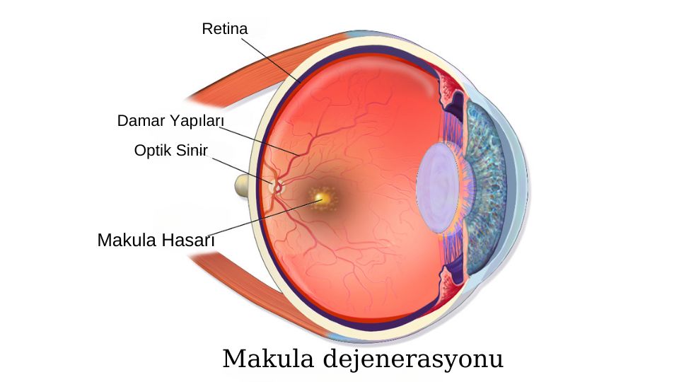 Makula dejenerasyonu görseli - DrCem hastalık rehberi